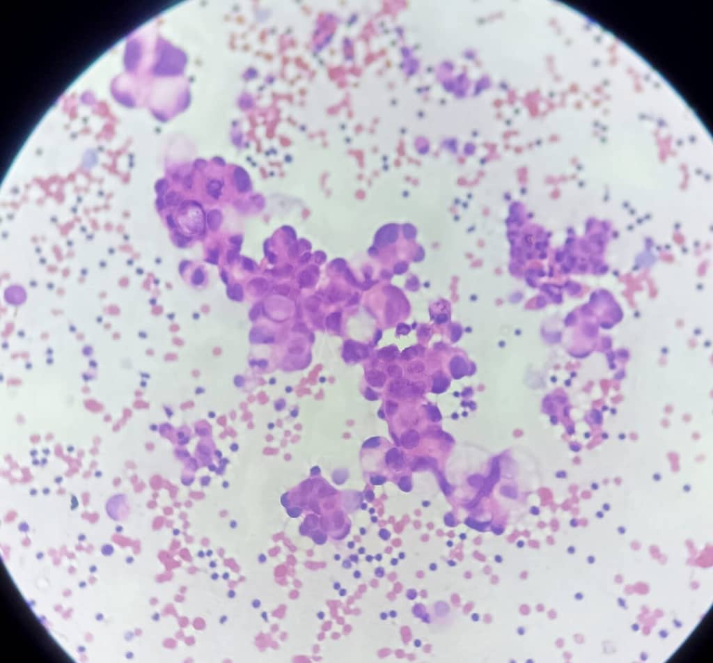 pleural fluid cytology smear showing metastatic cells of ovarian adenocarcinoma