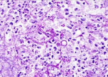PAS-D positive Aspergillus fungal Hyphae