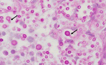 Budding cryptococcus -highlighted by PAS stain