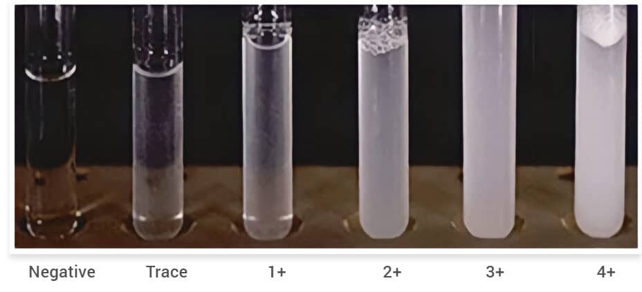 Sulfosalicylic-Acid-Test