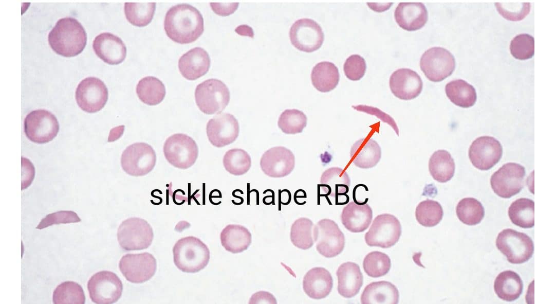 Sickling Test Sickling Test Procedure Clinical Laboratory Guide
