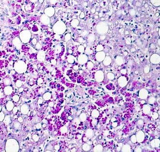 PAS-D liver biopsy, bright magenta coloured  globules seen in hepatocytes in alpha 1 antitrypsin deficiency
