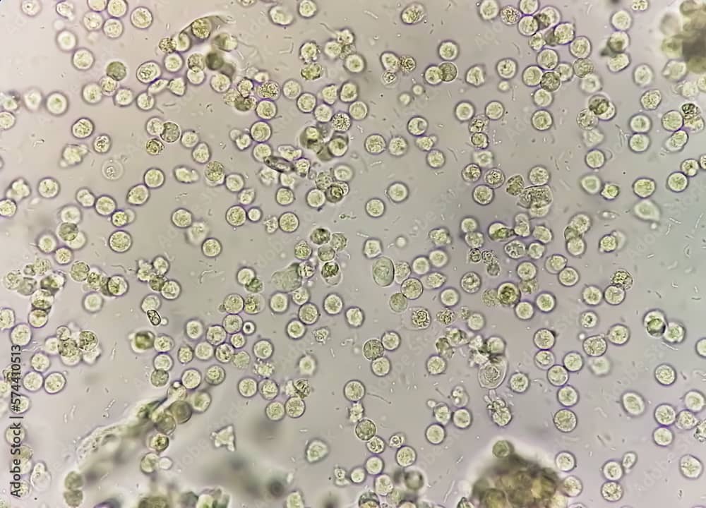 pus cells in urine microscopy