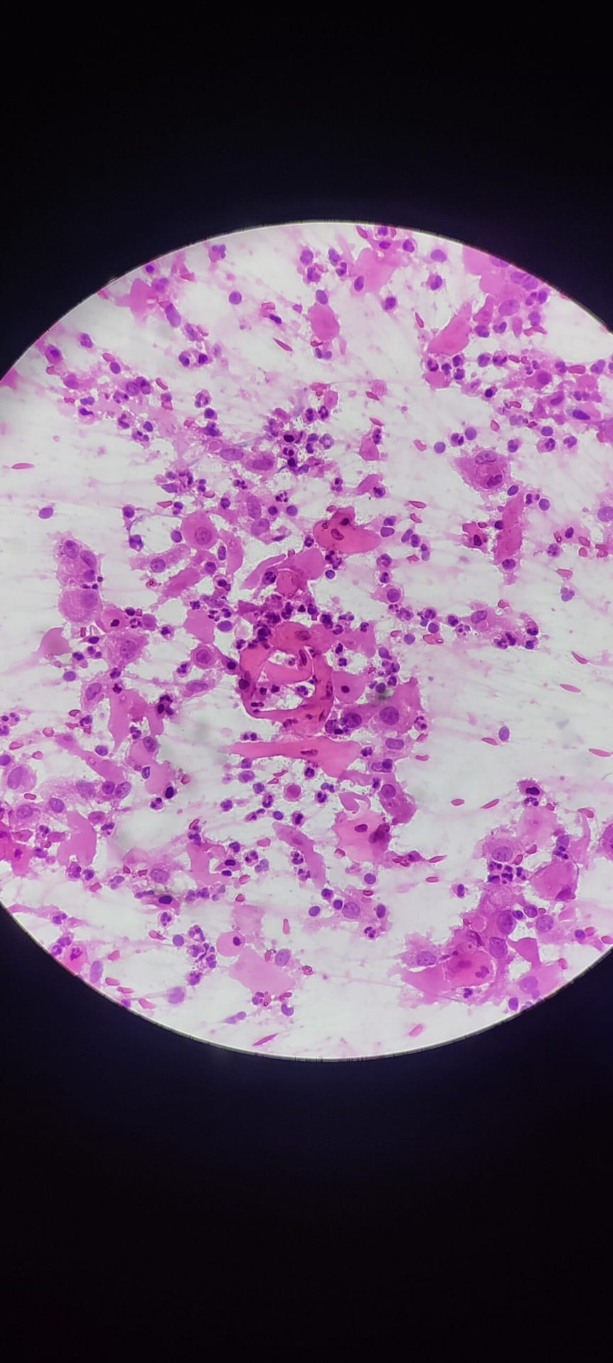 SCC CYTOLOGY