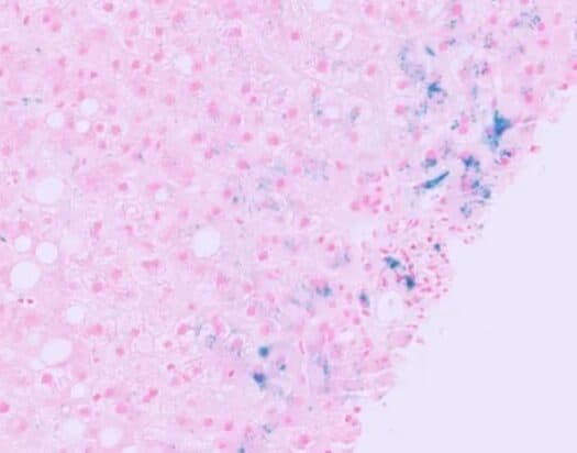 Perls stain , prussian blue reaction,hemosiderin demonstration